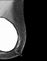The mammogram BI-RADS 2-benign shows a breast implant augmentation .