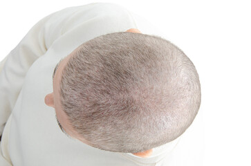 Overhead medical photo shows the soft, fluffy hair regrowth of a 62-year-old woman 70 days after chemotherapy, including some gray strands.