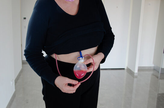 Post-Operative Care Essentials: Woman Demonstrates Proper Use of Drainage System After Breast Cancer Surgery