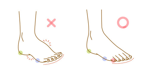 足の浮き指と正常な足裏のイラストセット © mw