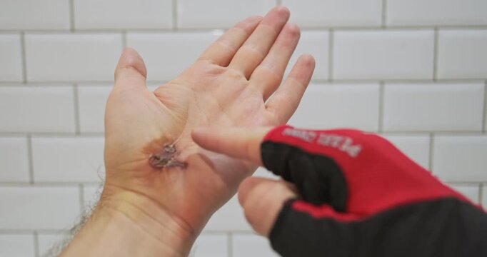 Injury from riding a bicycle without gloves. Man shows his injured palm. Why you should wear cycling gloves.