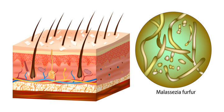Human hair with dandruff of microscopic fungi Malassezia furfur that cause dandruff and seborrhoeic dermatitis. 