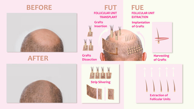 Methods of hair transplantation fut vs fue with infographic elements of illustration.