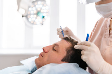 Closeup side view of unrecognizable female nurse drawing using pencil new hairline on head of patient male before hair transplantation surgery in clinic. Concept of professional baldness treatment.