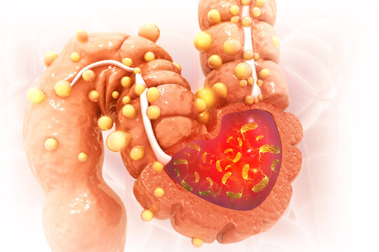 Visual concept of Bacterial infection of the colon, colon cancer. 3d illustration