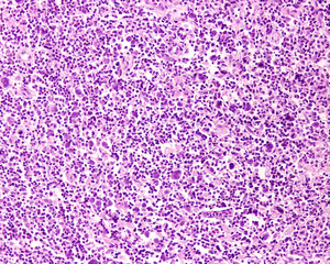 Lymph node. Hodgkin lymphoma