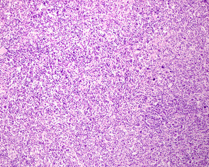 Lymph node. Hodgkin lymphoma