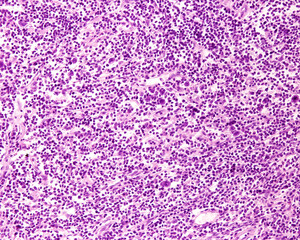 Lymph node. Hodgkin lymphoma