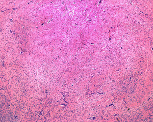 Muscle fibrosarcoma