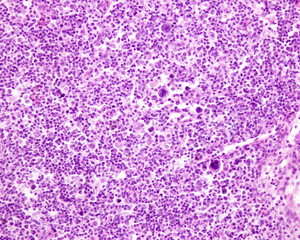 Lymph node. Hodgkin lymphoma