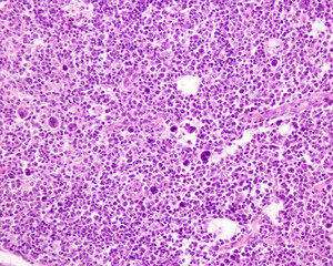 Lymph node. Hodgkin lymphoma
