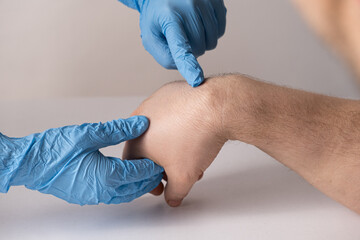 Ganglion cyst or hygroma of the wrist on the hand of a male patient, examination by a doctor