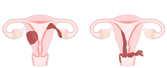 Blank Endometrial cancer (Uterine cancer) cancer images Stage 3A  and 3B Medical diagram PNG