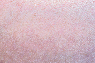dry and dehydrated human skin texture background