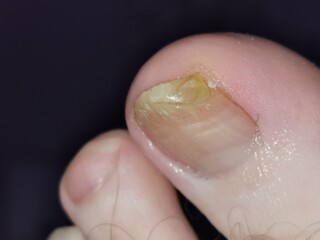 Fototapeta premium nail fungus on the leg finger
