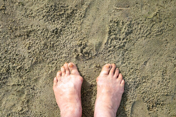 A woman's feet, deformed by illness, stand on the sand on the beach. A bone near the thumb. Gout or arthritis