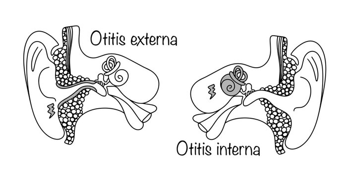 Otitis externa. Otitis Interna