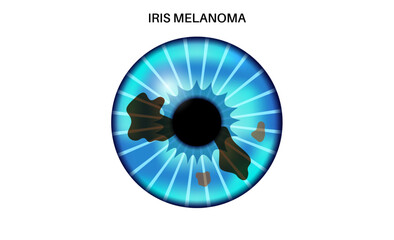 Iris melanoma anatomy