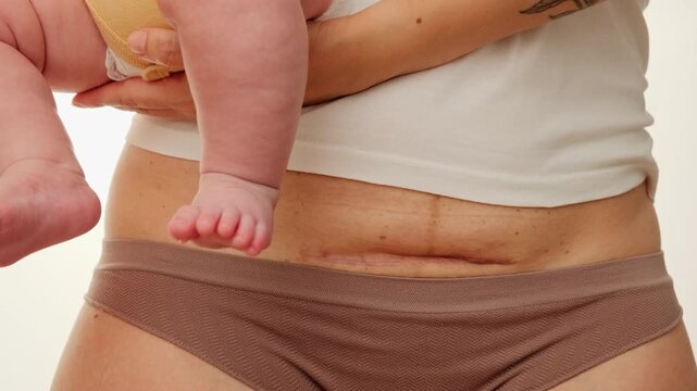 Woman belly with a scar from cesarean section with newborn baby's legs. Dolly shot of the abdomen with c-section scar. Cropped view of a mother holding baby showing a real body. Postpartum recovery.