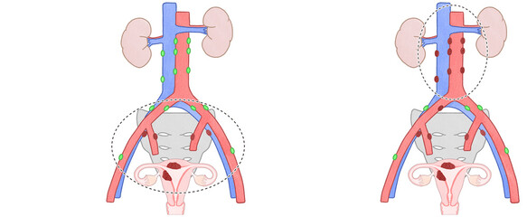 Blank Endometrial cancer (Uterine cancer) cancer images Stage 3C1  and 3C2
