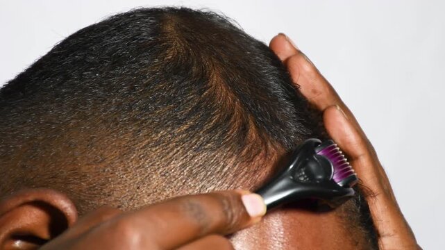 close up of young man Micro needling, using derma roller on head for stimulating new hair growth and reduce hair loss or Androgenetic alopecia. derma roller on bald area improve hair regrowth therapy