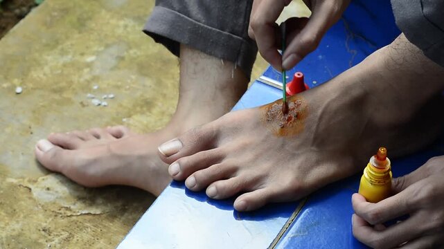 Close up of a wounded and itchy foot being dripped with red medicine