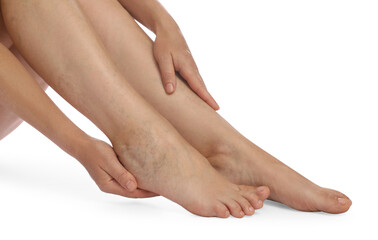 Woman suffering from varicose veins on white background, closeup