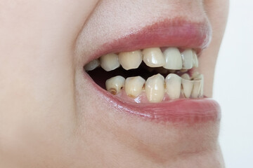 Caries and plaque. Open mouth close-up.