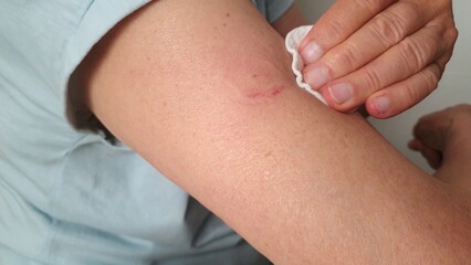 Stage 2. Disinfection of a wound after removing the non-contact glucose meter from the arm to...