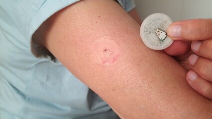 Stage 1: Instructions for removing the non-contact glucose meter from your arm to quickly measure...