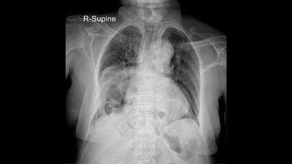 Diagnostic PA Chest X-ray: Comprehensive Assessment of Thoracic Health and Respiratory Conditions