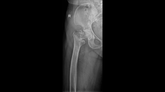 AP Radiograph of Hip Joint Fracture in an Adult Patient