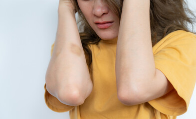 Cropped shot view of Asian woman showing bruise occur on her skin.