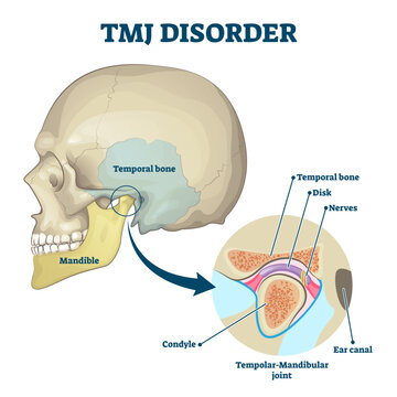 TMJ disorder illustration, transparent background.Labeled jaw condition educational scheme.Diagram with joint clicking and pain anatomical structure and explanation.