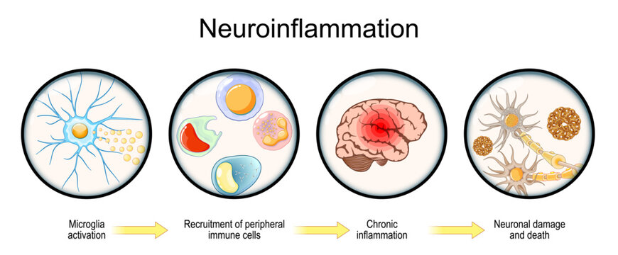Neuroinflammation.