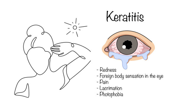 Keratitis