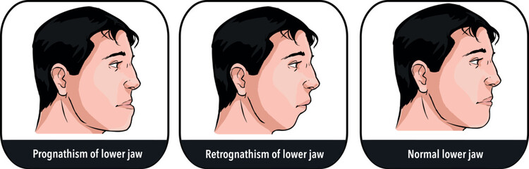 Deformities of mandibular with normal jaw, prognathism and petrognathia
