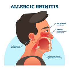 Allergic rhinitis medical diagram, illustration labeled information, transparent background. Patient symptoms like red, itchy eyes, sneezing and runny nose, sore throat and buzzing sound in ears.