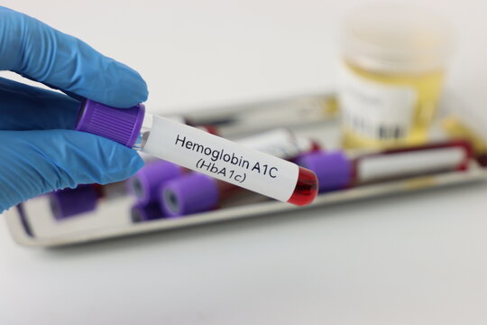 Blood exam sample for hemoglobin test in a professional wearing gloves and other blood samples and urine sample blurred in the background. Check up for hemoglobin values 