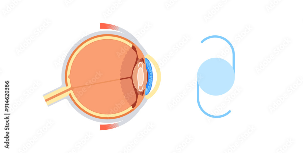 Poster Intraocular lens poster