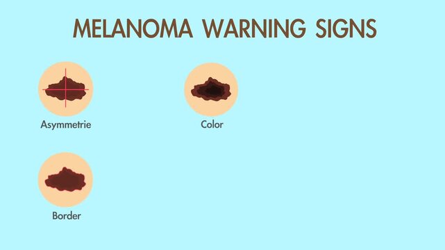 ABCDE rule of skin cancer. Skin cancer symptoms. Warning signs of a melanoma. Asymmetrie, Border, Color, Diameter and Evolving. Health care themed animation.