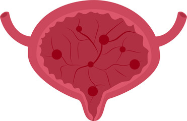 Urinary bladder disease. Cystitis bladder Illustration.