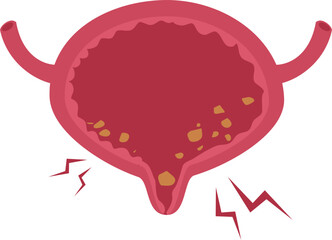 Urinary bladder disease.Bladder stones Illustration.