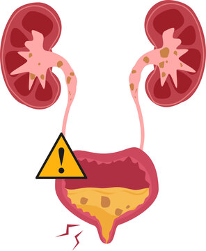 Urinary bladder disease. Bladder stones Illustration.