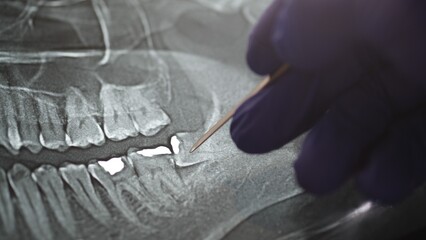Panoramic Xray tooths showing Amalgam that used for dental  restorative material of choice due to...