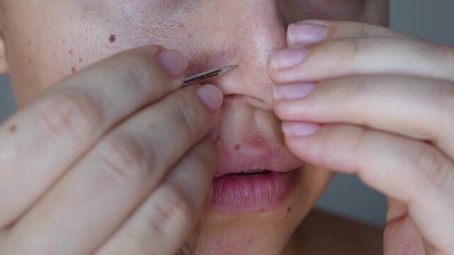 Close up of a young woman getting rid of black heads or comedones using Uno spoon on a dark grey background. Acne problem, pimples. Cosmetology dermatology concept