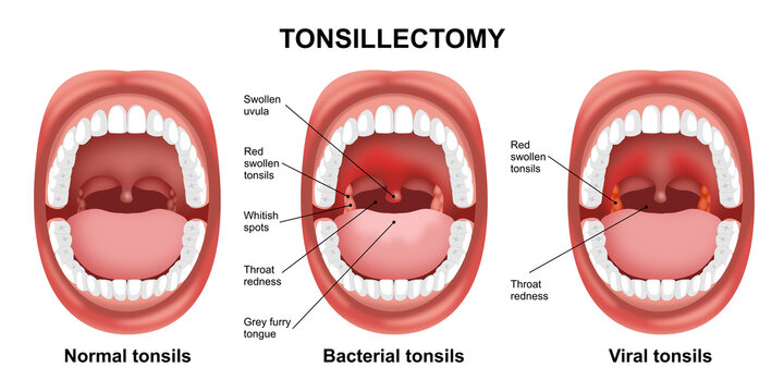 Tonsillectomy, bacterial and viral tonsil in mouth illustration infection