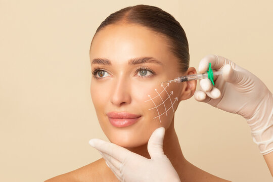 Beauty injections. Lifting lines on young woman's face showing skin tightening and face contour correction with beauty injections