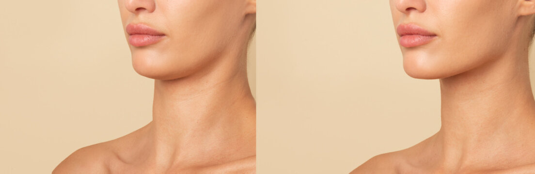 Double chin lift concept. Woman before and after plastic surgery or facebuilding procedures. Chin fat removal and face contour correction concept