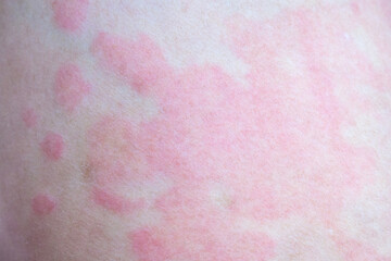 Skin allergy rash dermatitis texture close up